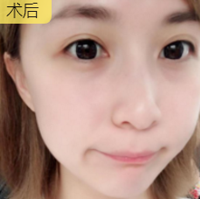 面部提升术