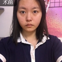 面部提升术
