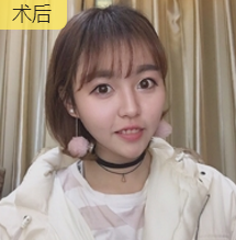 面部提升术