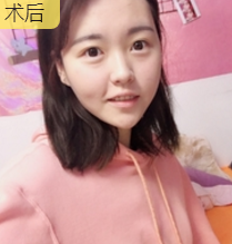 面部提升术