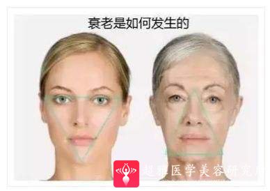 面部提升术