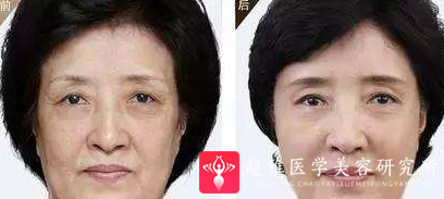 面部提升术