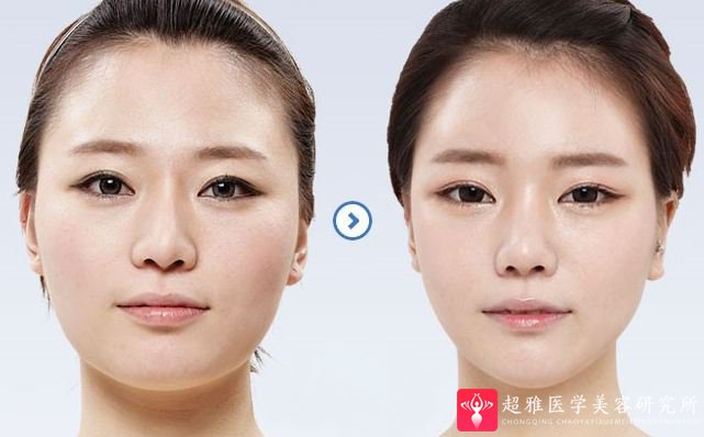 超声波瘦脸