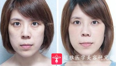 去眼袋手术