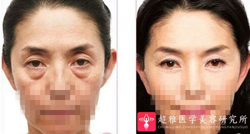 去眼袋手术