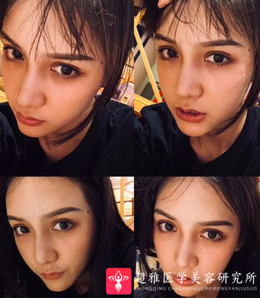 隆鼻手术