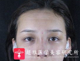 隆鼻手术