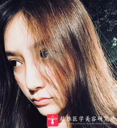 隆鼻手术