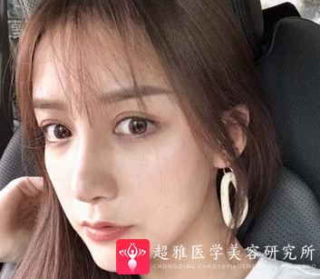 隆鼻手术