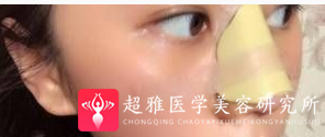 隆鼻手术