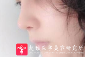 隆鼻手术