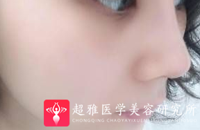 隆鼻手术