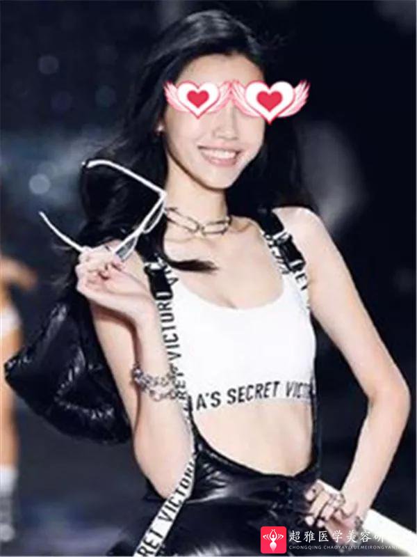 自体脂肪填充术