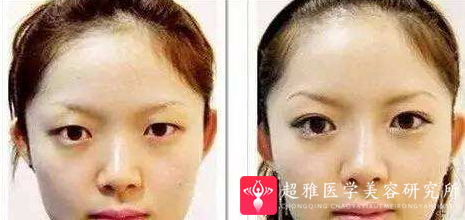 自体脂肪填充术