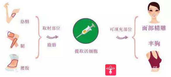 自体脂肪填充术
