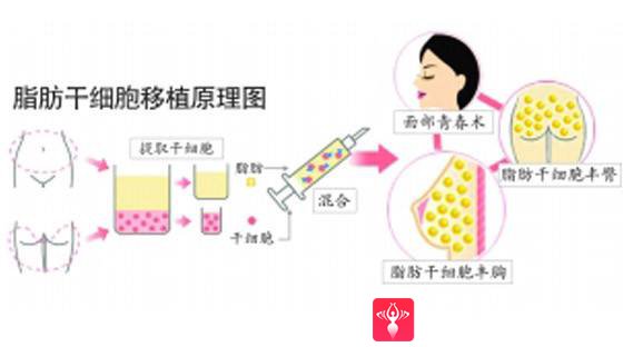 自体脂肪填充术