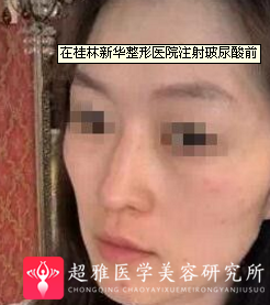 自体脂肪填充术