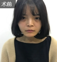 面部提升术