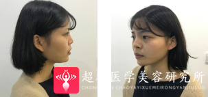 面部提升术