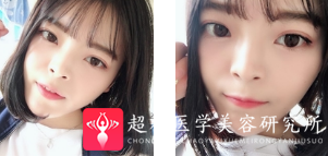 面部提升术