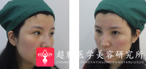 面部提升术