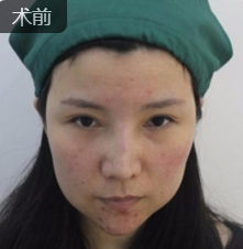 面部提升术