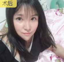面部提升术