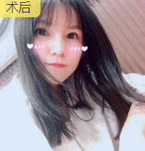 面部提升术