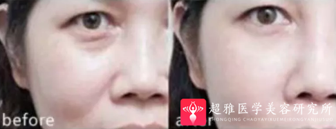 玻尿酸