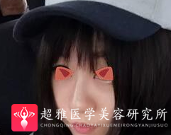 不开刀隆鼻
