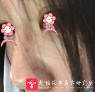 不开刀隆鼻
