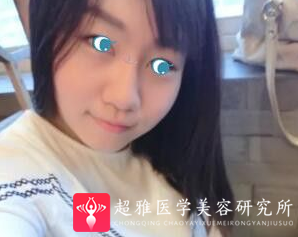 不开刀隆鼻