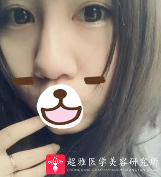 不开刀隆鼻