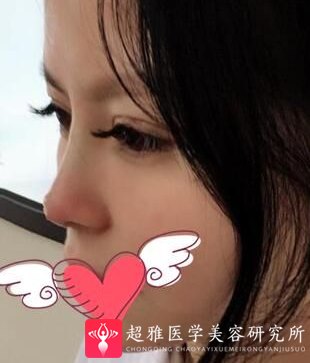 不开刀隆鼻