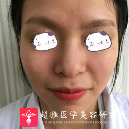 不开刀隆鼻
