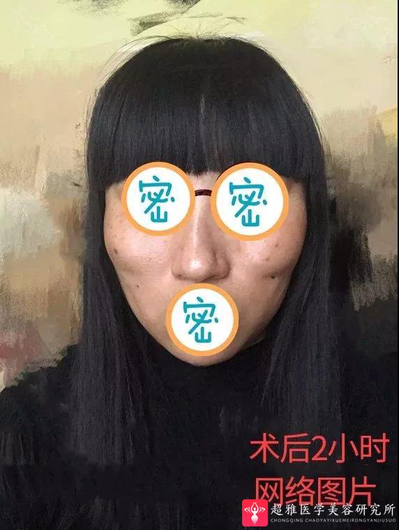 面部提升术