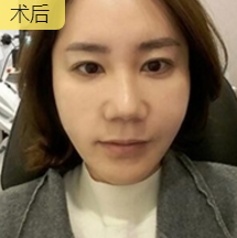 面部提升术