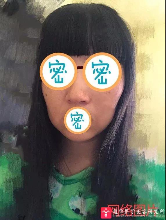 面部提升术