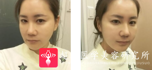 面部提升术