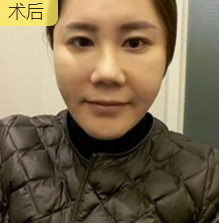 面部提升术