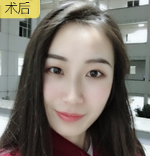 面部提升术