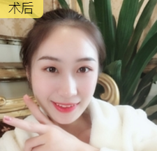 面部提升术