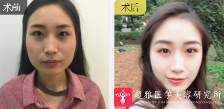 面部提升术