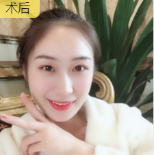 面部提升术