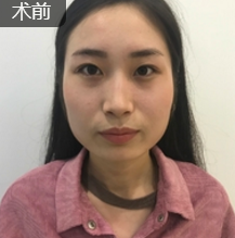 面部提升术