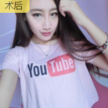 面部提升术