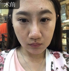 面部提升术