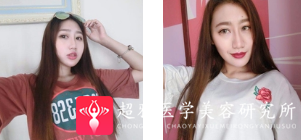 面部提升术