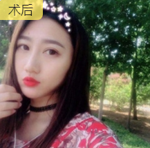 面部提升术