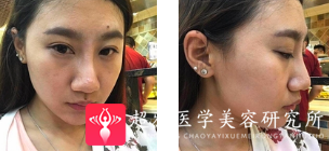 面部提升术
